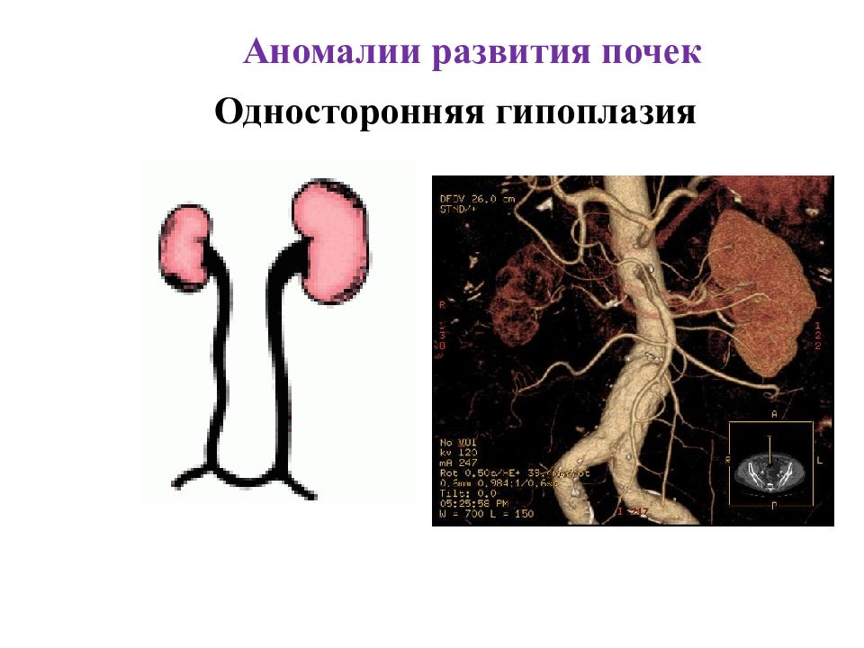 Аномалия развития почек презентация