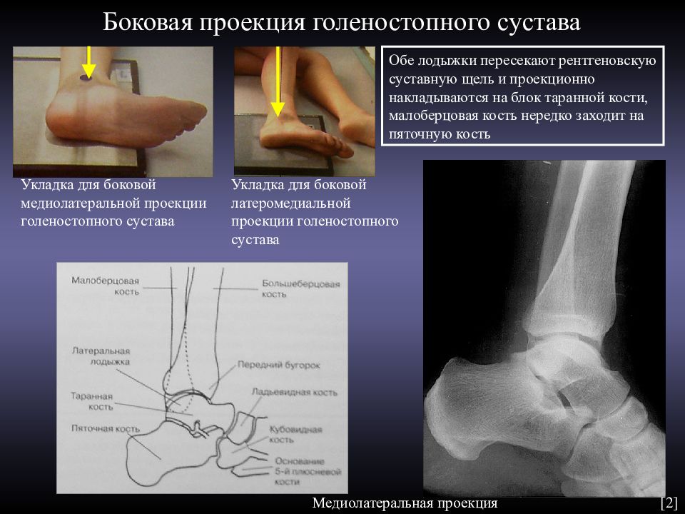 Суставы проекция. Голеностопный сустав рентген анатомия. Проекция Мортис в рентгенографии голеностопного сустава. Рентгеноанатомия голеностопного сустава. Боковая проекция голеностопного сустава.