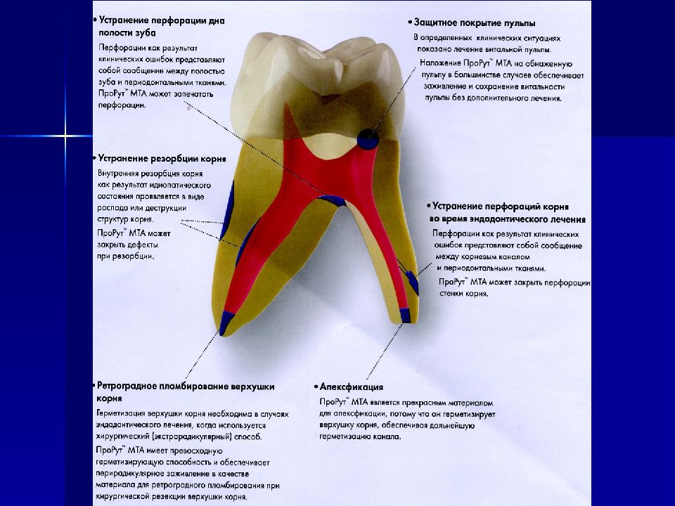 Перфорация корня зуба. Перфорация полости зуба. Перфорация дна полости зуба. Перфорация стенки полости зуба. Перфорация дна полости зуба устранение.