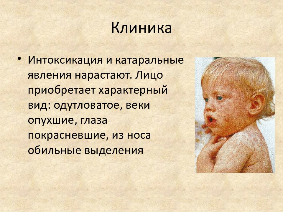 Характерные симптомы катарального периода кори