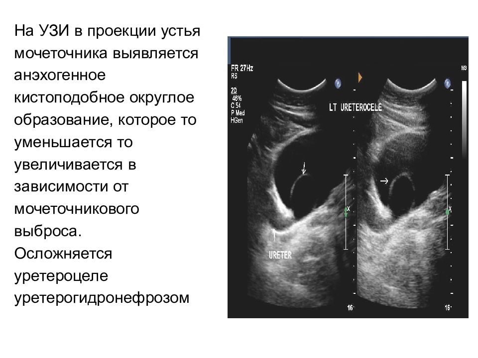 Узи почек и мочевого пузыря презентация