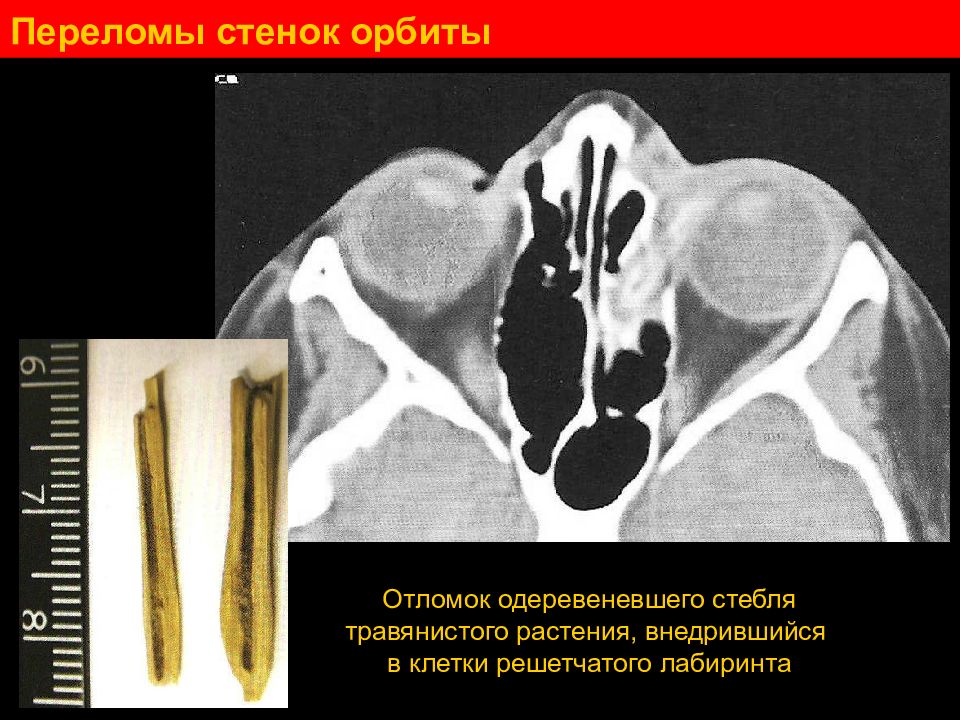 Перелом медиальной стенки орбиты