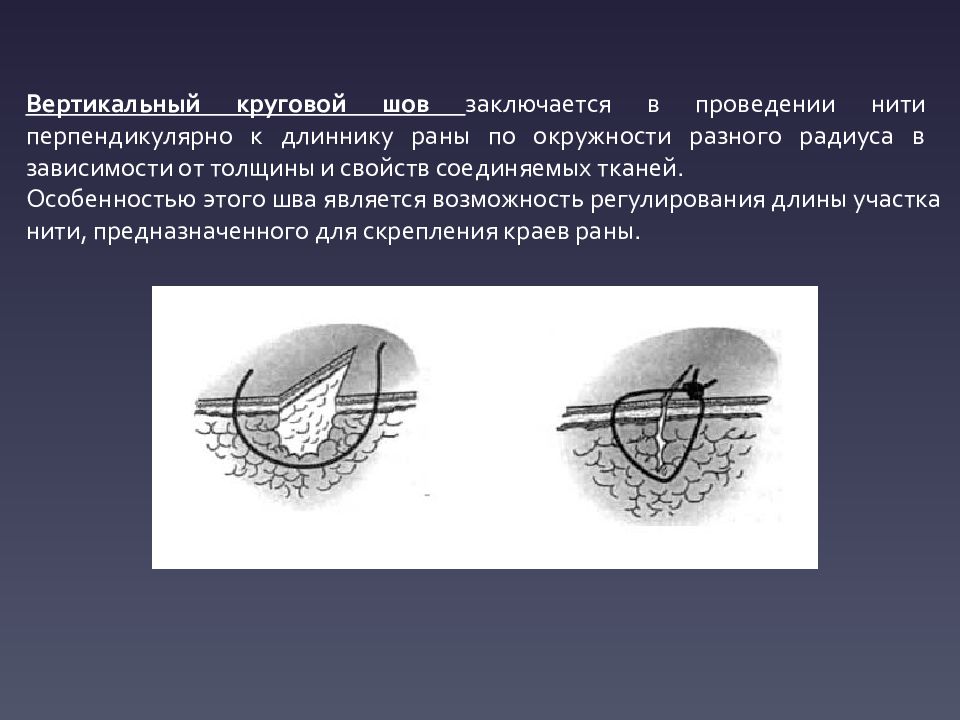 Хирургические швы презентация