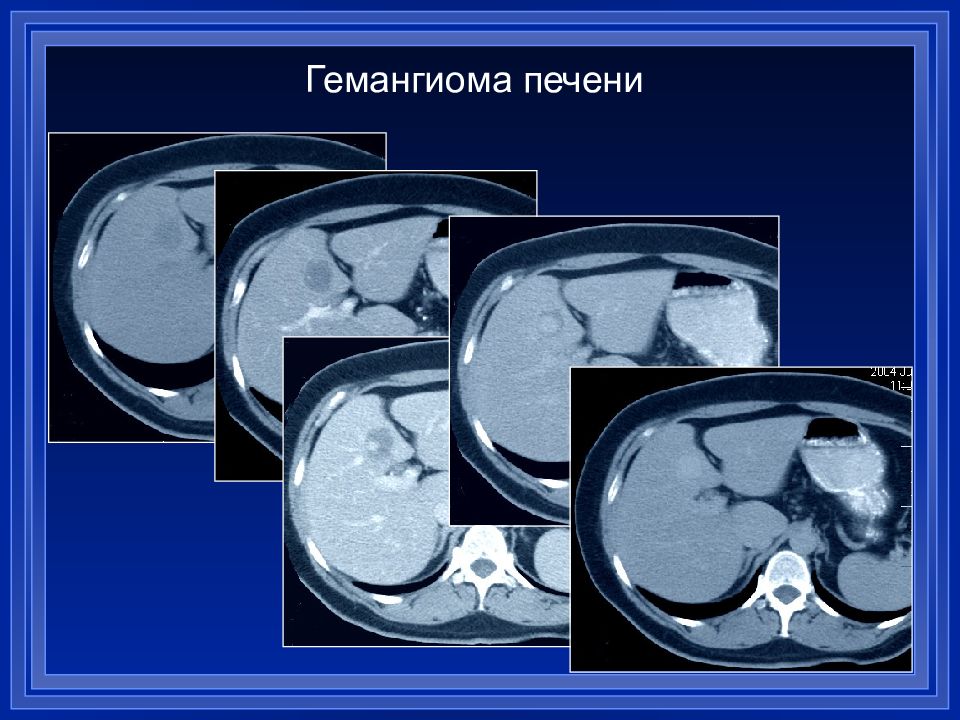 Лечение гемангиомы печени. Гемангиома печени диф диагноз. Капиллярная гемангиома печени на кт. Капиллярная гемангиома печени мрт. Крупная гемангиома печени кт.