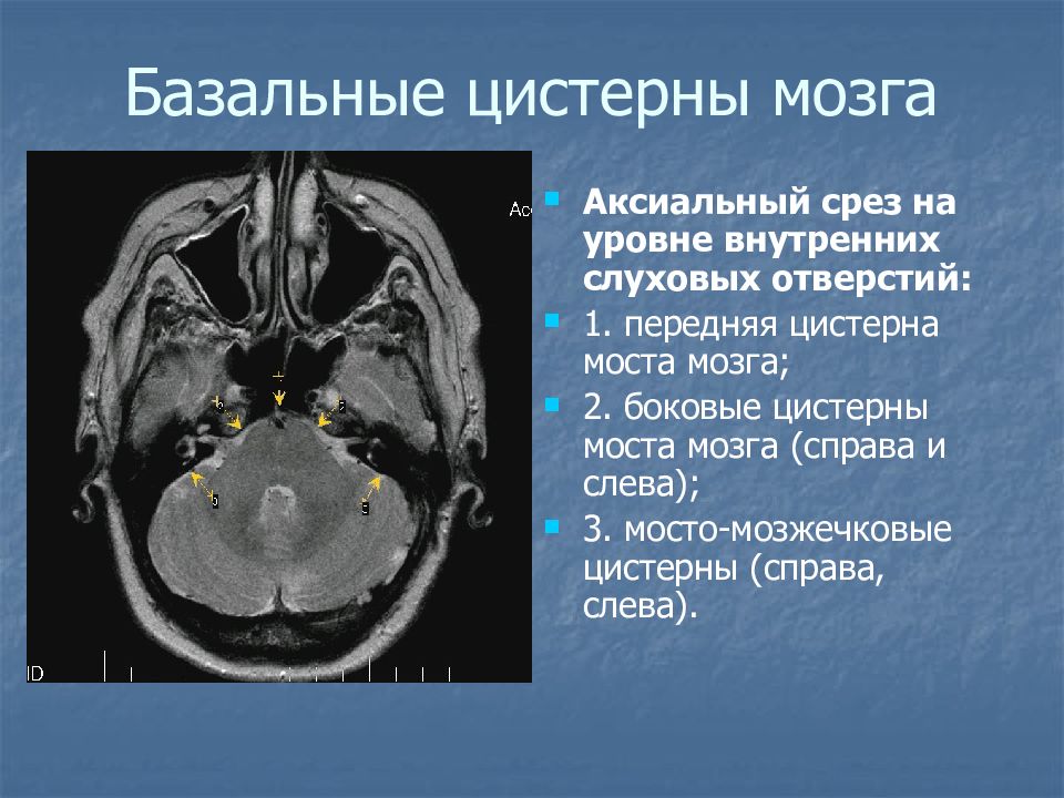 Цистерна мозга норма