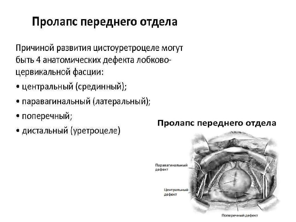 Пролапс тазовых органов фото