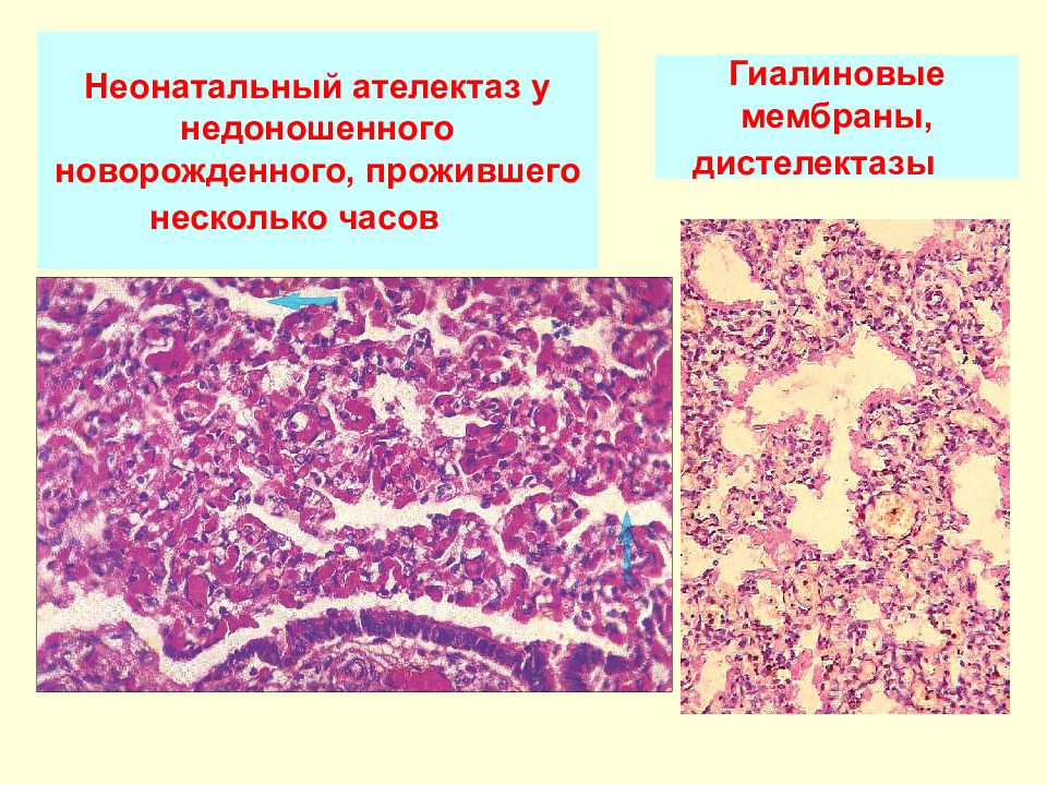 Болезнь гиалиновых мембран у новорожденных презентация