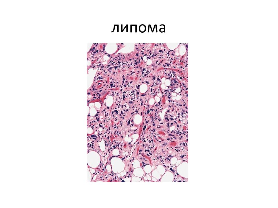 Атерома цитологическая картина