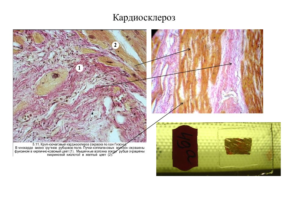 Кардиосклероз рисунок микропрепарат