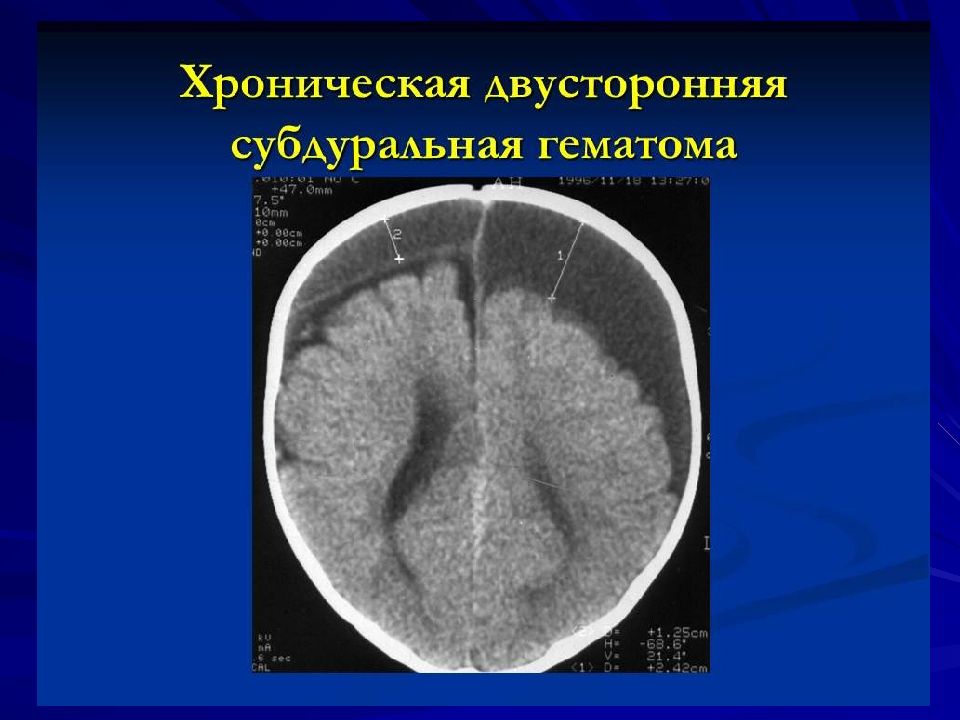 Острая субдуральная гематома клиническая картина