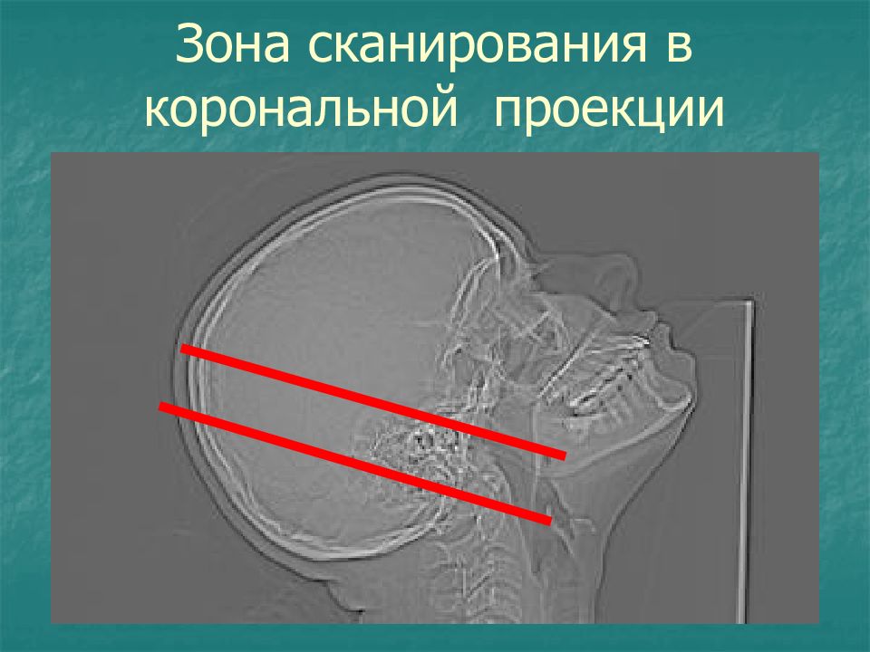 Аксиальная проекция. Височная кость корональная проекция кт. Корональная проекция кт. Аксиальная проекция кт. Височные кости в аксиальной проекции.