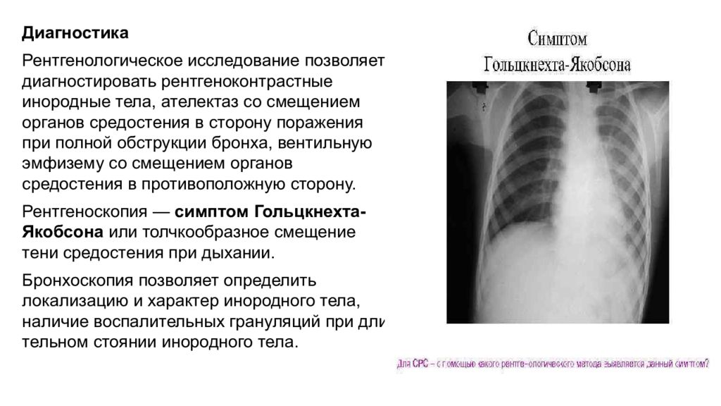 Туберкулез трахеи презентация