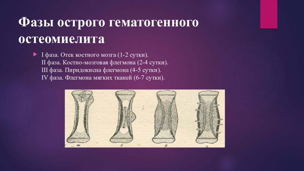 Фазы остеомиелита. Фазы острого гематогенного остеомиелита. Гематогенный остеомиелит фазы. Стадии острого гематогенного остеомиелита. Стадии гематогенного остеомиелита.