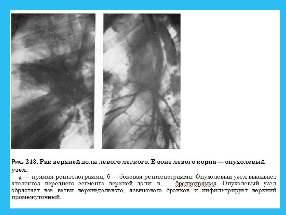 Рак легких 8 класс презентация