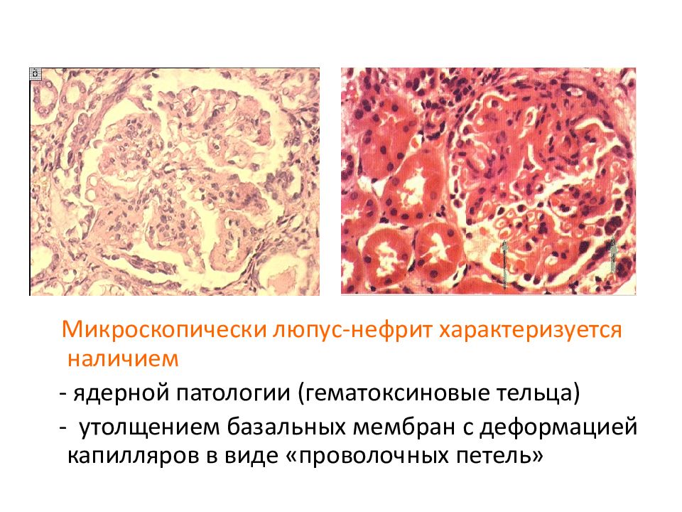 Люпус нефрит презентация