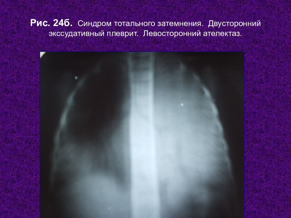 Тотальное затемнение. Экссудативный плеврит легочной синдром. Пневмония с плевритом рентген. Левосторонний экссудативный плеврит. Двусторонний экссудативный плеврит.