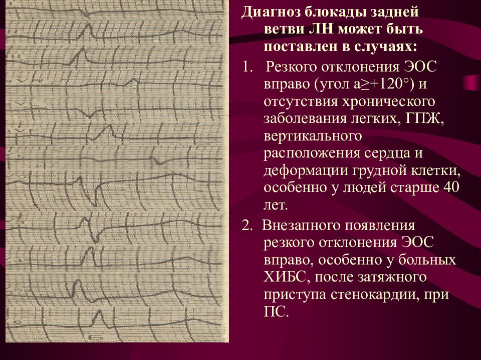 Блокада левой задней ножки. Блокада задней ветви ЛНПГ на ЭКГ. Отклонение пучка Гиса ЭОС вправо. Блокада задней ветви левой ножки пучка Гиса на ЭКГ. Неполная блокада задней ветви.