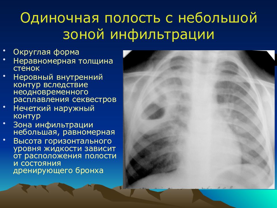 Острая гнойная деструктивная пневмония у детей презентация