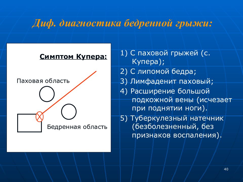 Паховая грыжа у мужчин симптомы. Симптом Купера бедренная грыжа. Симптом Купера при грыже.