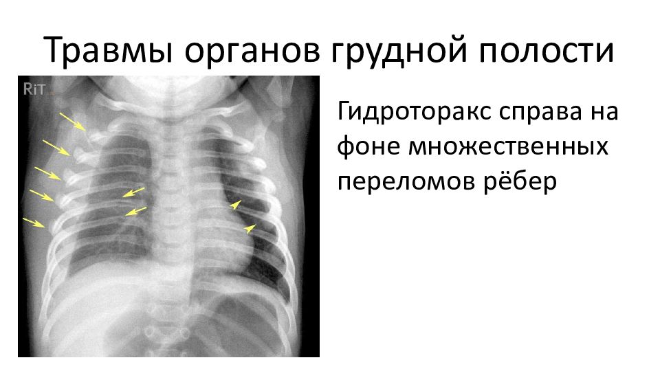 Гидроторакс легких карта вызова