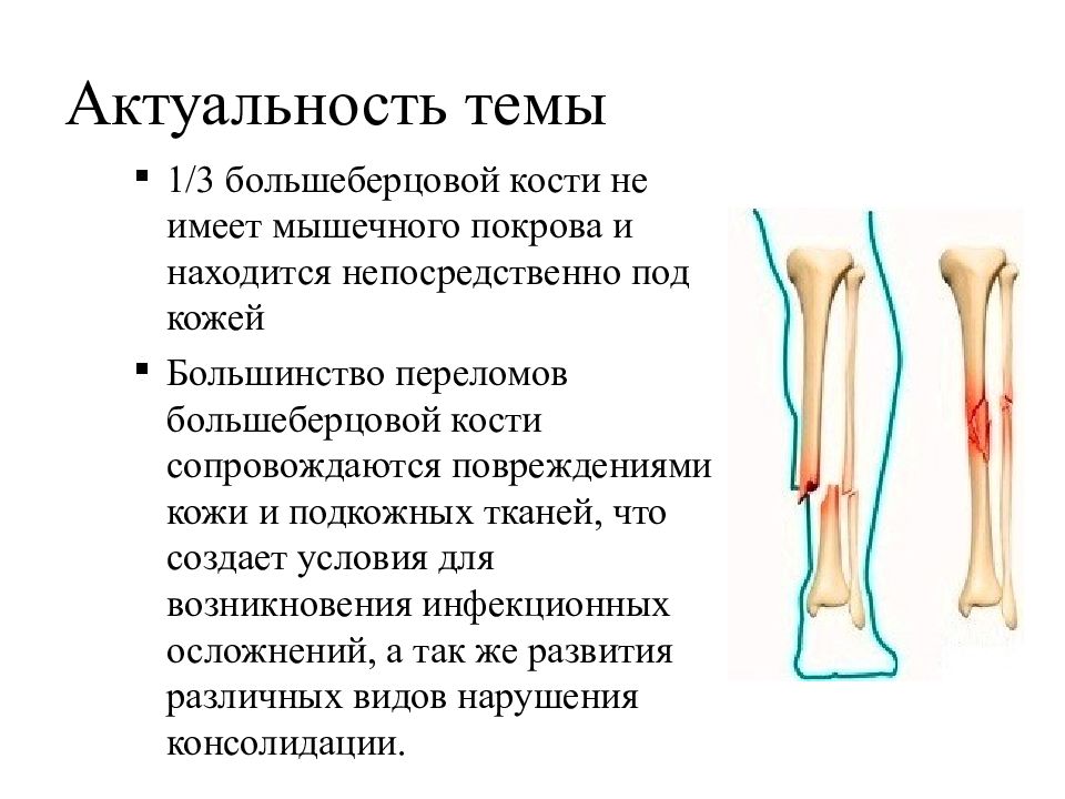 Презентация про переломы