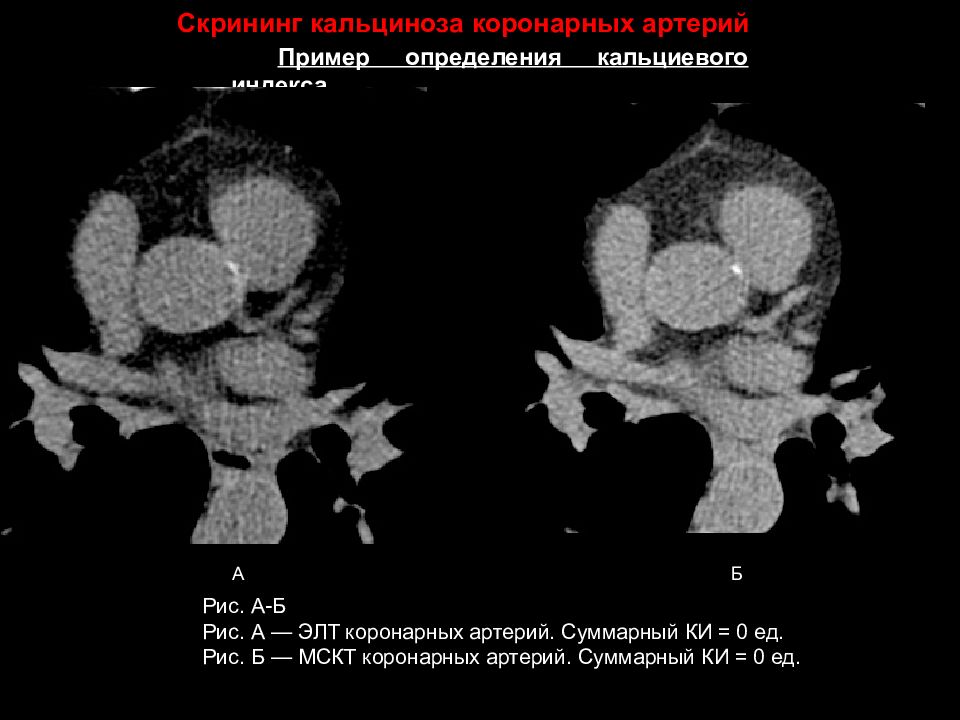 Кт скрининг коронарного кальция