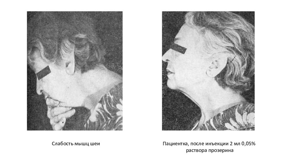 Слабость мышц. Бульбарная миастения симптомы. Генерализованная миастения.