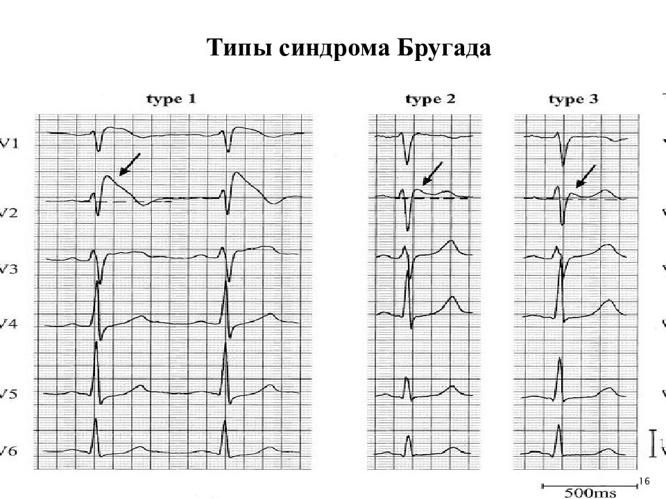 Типы синдромов. Синдром Бругада 2 типа. Синдром Бругада на ЭКГ типы. Синдром Бругада 1 Тип на ЭКГ. Синдром Бругада ЭКГ признаки.