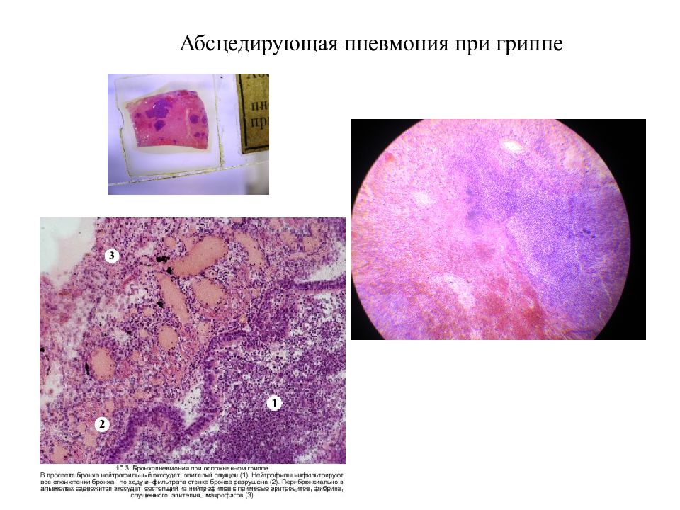 Очаговая пневмония рисунок микропрепарат