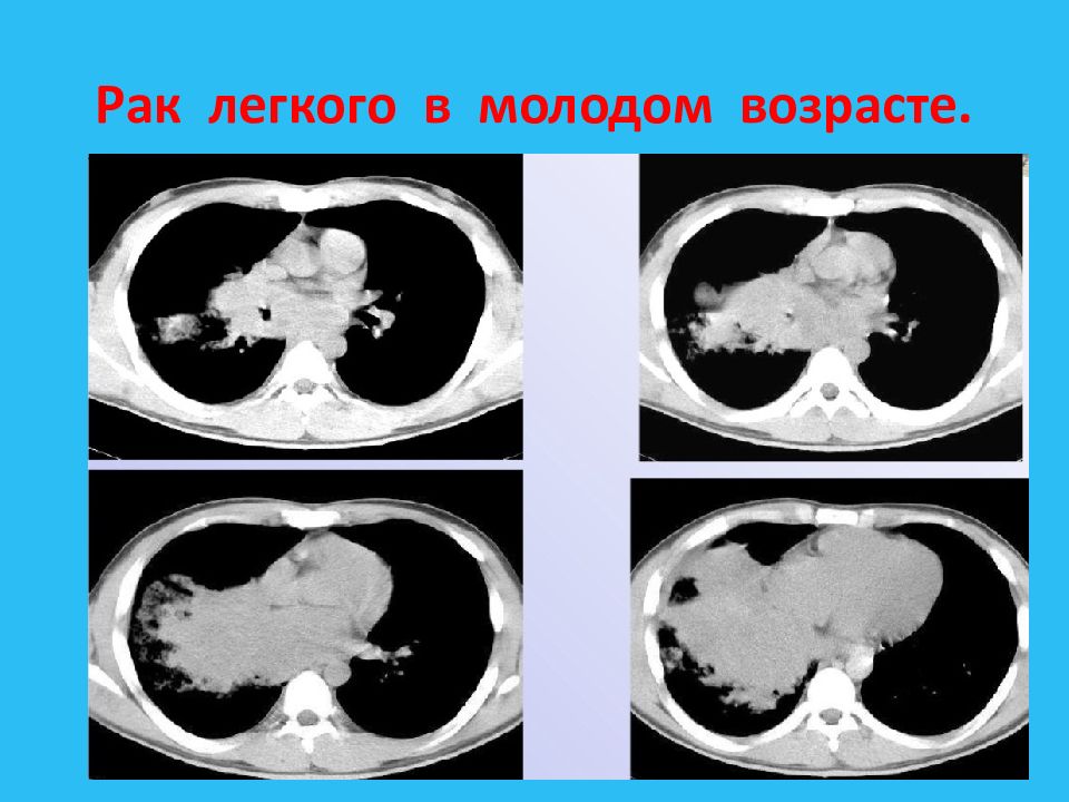 Центральный рак легкого. Экзофитные опухоли легкого. Эндофитный рост опухоли легкие.