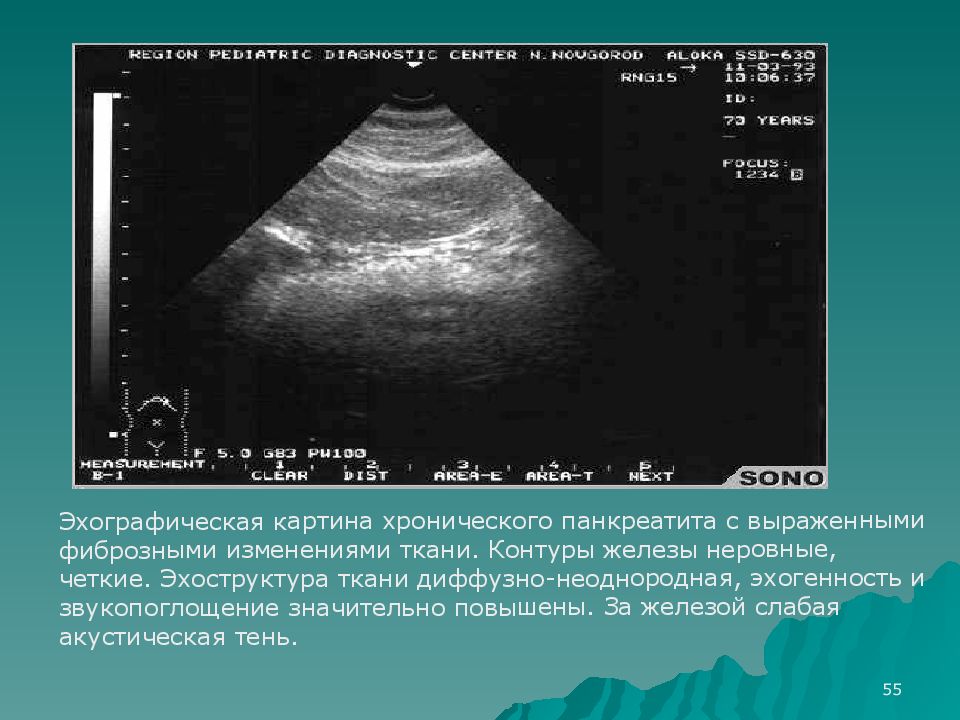 Эхографическая картина диффузных изменений паренхимы печени и поджелудочной железы