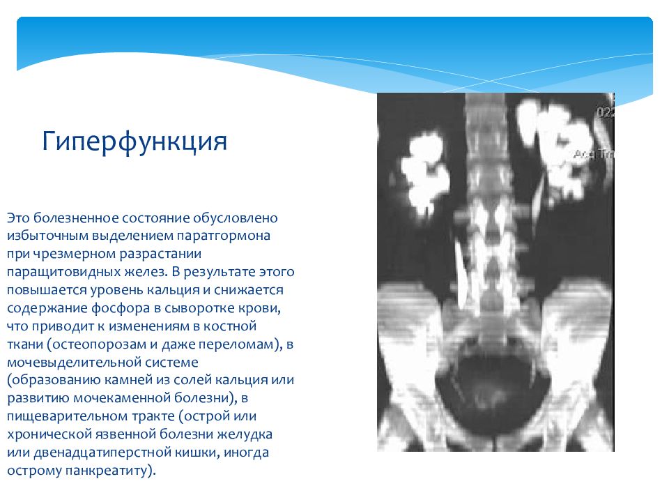 Гипофункция паращитовидной железы. При гиперфункции паращитовидных желез наблюдается. Гиперфункция паращитовидной железы. Гипофункциональное заболевание паращитовидной железы. При гипофункции паращитовидных желез наблюдается.