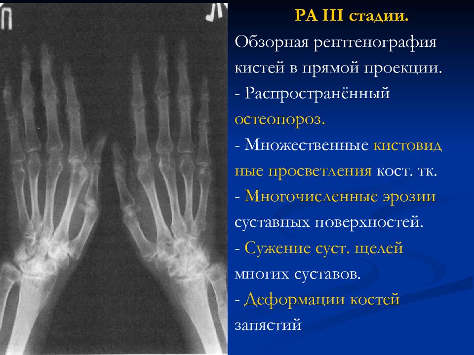 Рентгенологическая картина при ревматоидном артрите