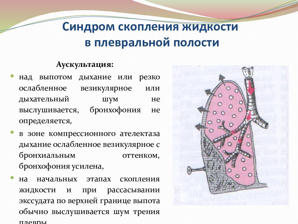 Плевральная жидкость. Жидкость плевральной полости аускультативно. Скопление жидкости в плевральной полости. Синдром жидкости в плевральной полости. Синдром скопления жидкости.