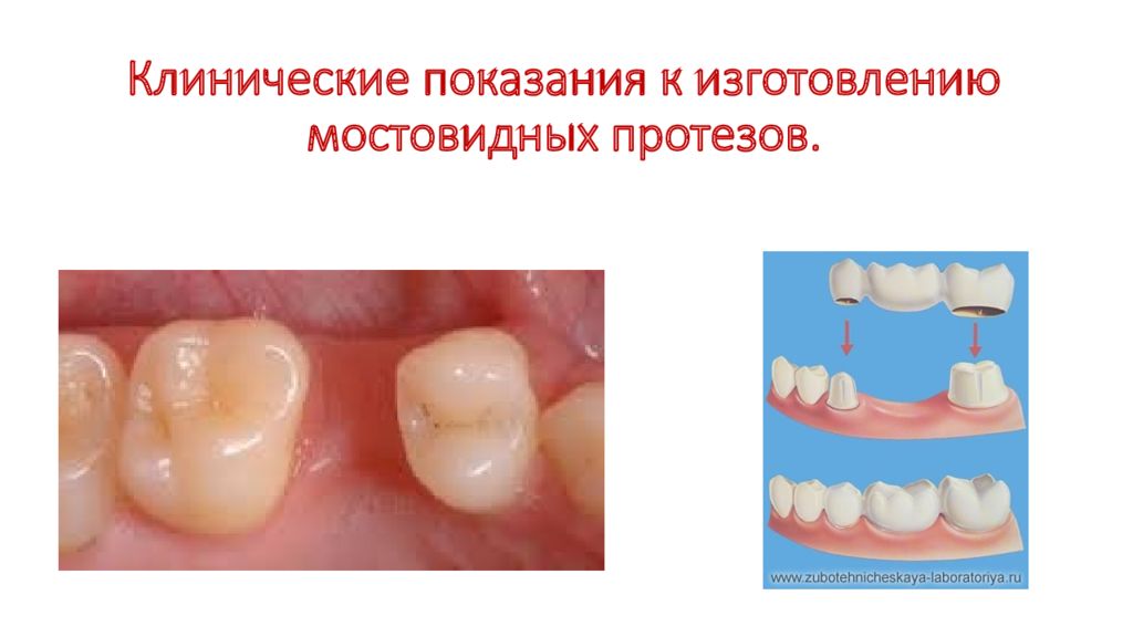 Клинические показания к изготовлению мостовидных протезов.