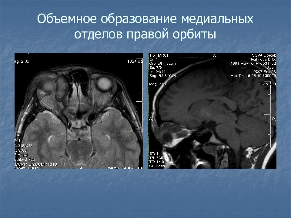 Объемное образование. Объемное образование орбиты. Объемное образование правой орбиты. Объемное образование орбиты мрт.