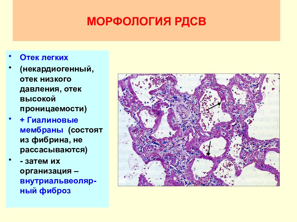 Болезнь гиалиновых мембран у новорожденных презентация