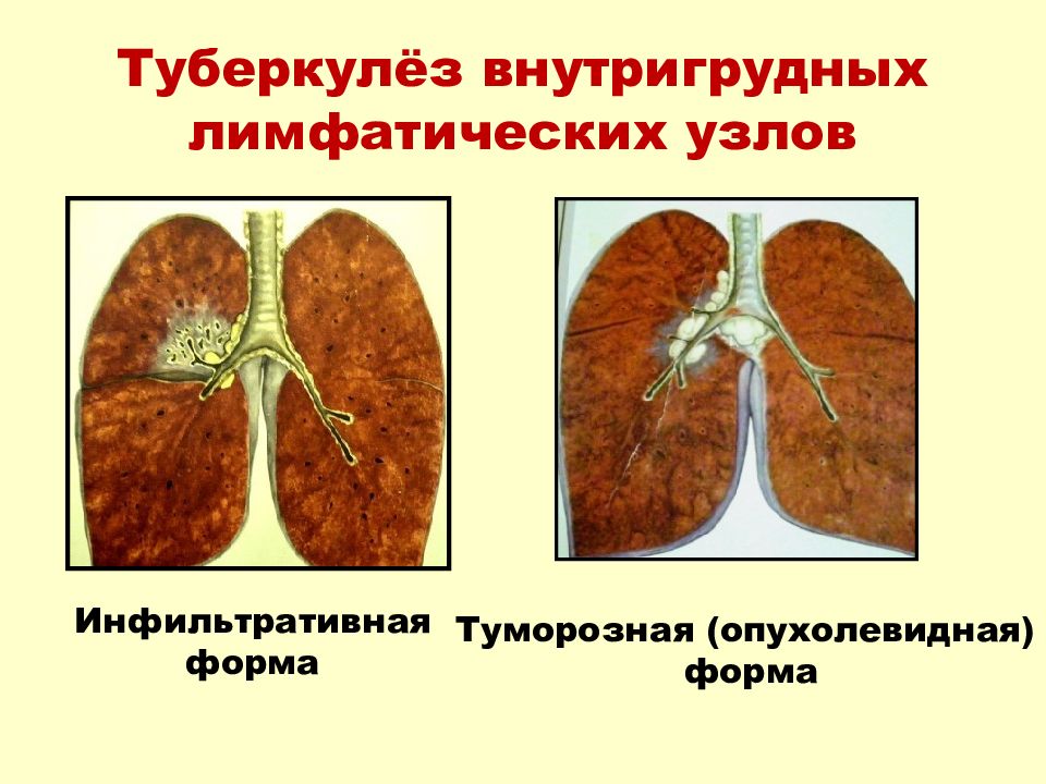 Первичный туберкулез картинки