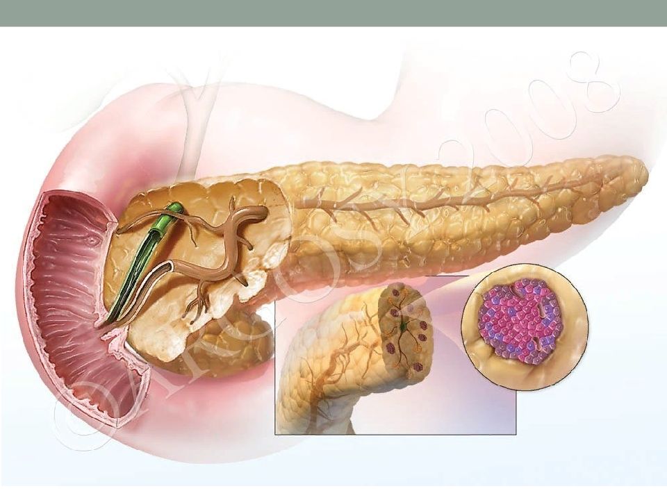 Поджелудочная железа рак симптомы. Паротитный панкреатит. Фиброз поджелудочной железы это панкреатит?. Поджелудочная железа 3д анатомия. Панкреатит макропрепарат.