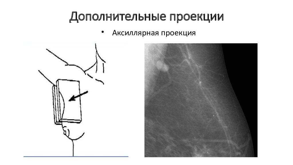 Дополнительные проекции. Маммография в боковой проекции. Аксиллярная проекция. Аксиллярная проекция молочной железы. Маммограмма аксиллярное.