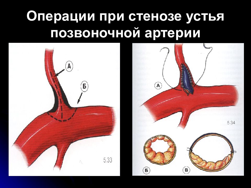 Сужение правой артерии. Позвоночная артерия операция. Устья позвоночных артерий. Стеноз артерий операция. Стеноз позвоночной артерии.