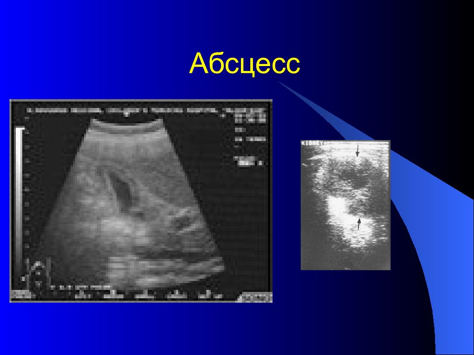 Ультразвуковое исследование органов забрюшинного пространства. Абсцесс брюшной полости по УЗИ. УЗИ органов брюшной полости и забрюшинного пространства. Абсцесс брюшной полости на УЗИ.