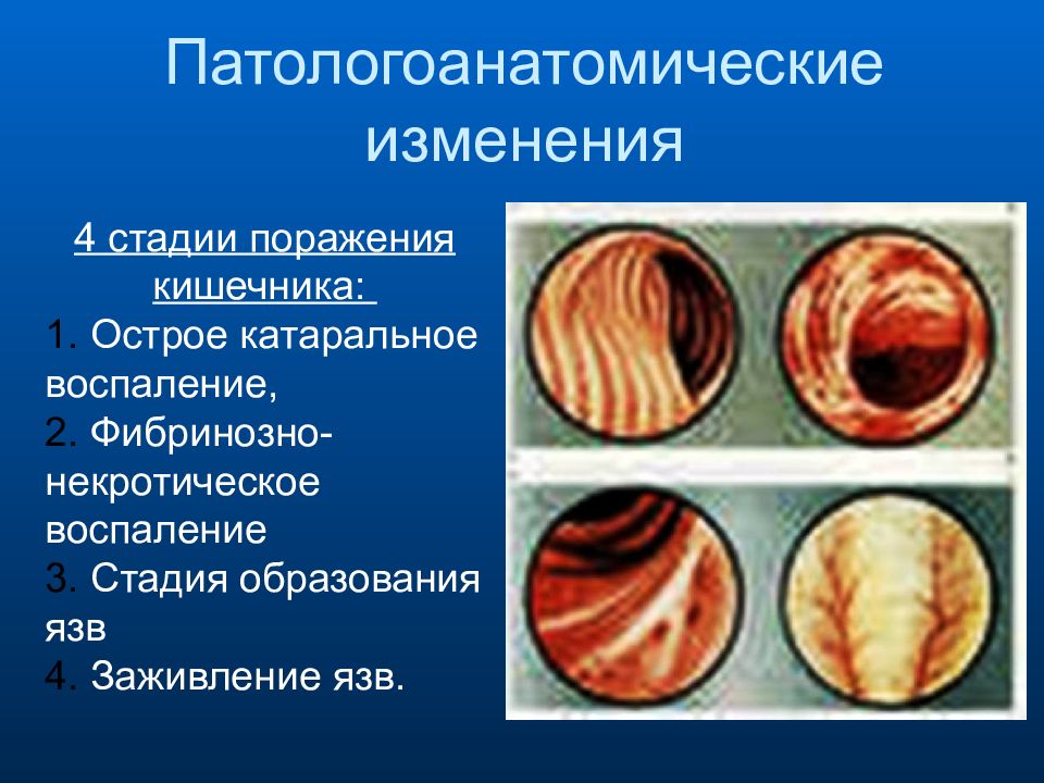 Стадии поражения. Острое катаральное воспаление. Патологоанатомические изменения. Стадия острого катарального воспаления. Стадии образования язвы.