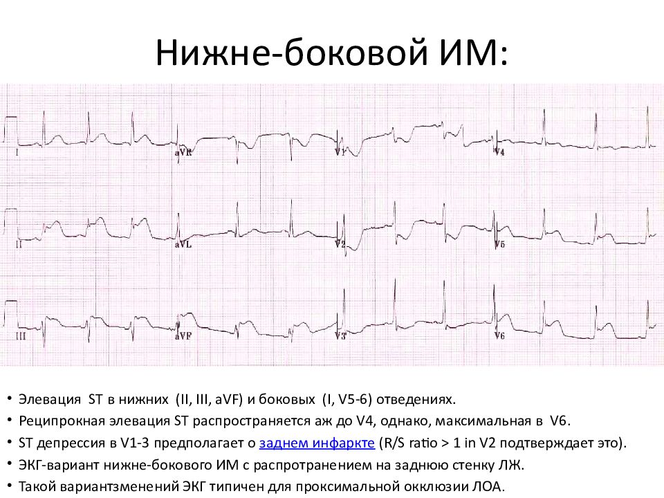 Боковой инфаркт на экг. Острейшая стадия инфаркта миокарда ЭКГ. ЭКГ при переднебоковом инфаркте миокарда. Переднеперегородочный инфаркт миокарда на ЭКГ. Изменения на ЭКГ при инфаркте миокарда.