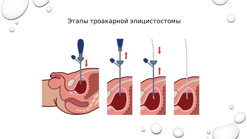 Цистостомия у мужчин