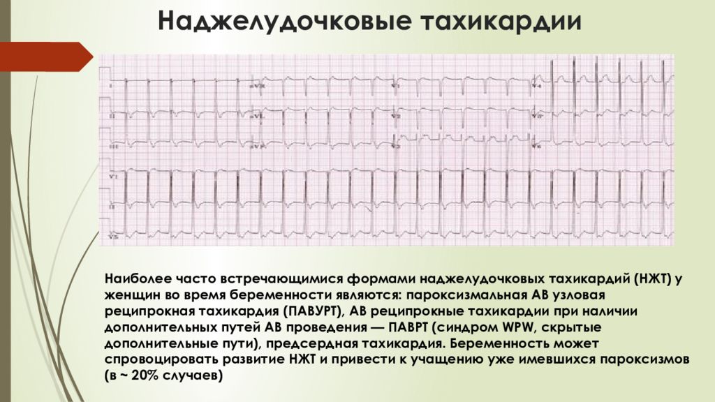 Тахикардия при беременности. ЭКГ при пароксизмальной наджелудочковой тахикардии. Наджелудочковая тахикардия на ЭКГ. Наджелудочковая тахикардия АВ Узловая реципрокная тахикардия. Суправентрикулярная форма тахикардии.