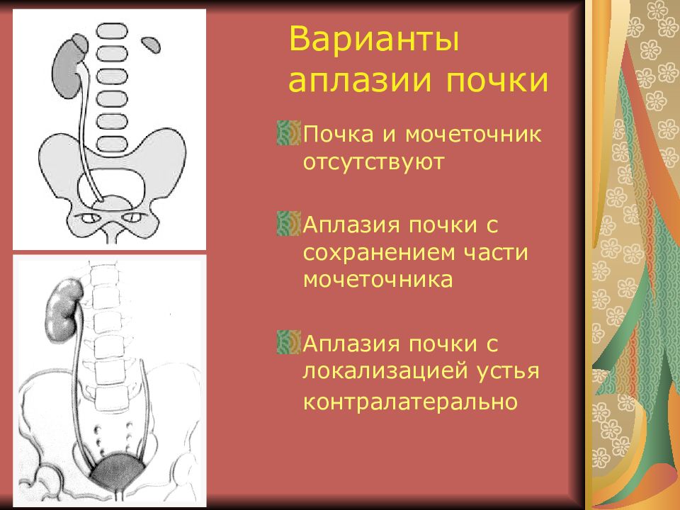 Аплазия это в медицине. Большая и малая аплазия почки. Односторонняя аплазия почки. Агенезия и аплазия почки.