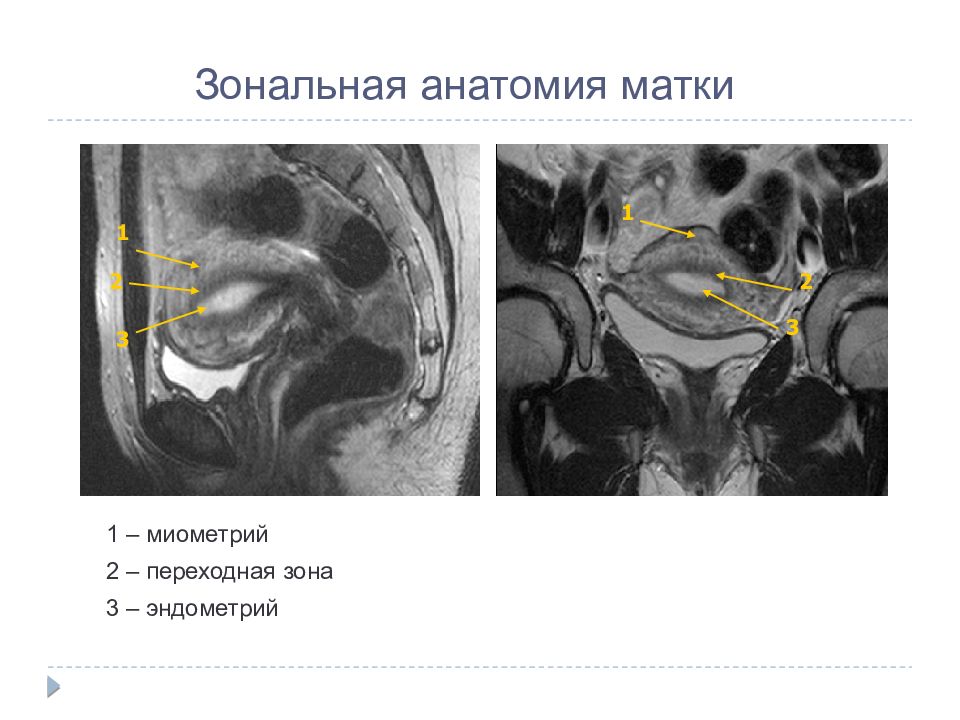 Мрт матки. Переходная зона матки на мрт. Зональная анатомия матки.