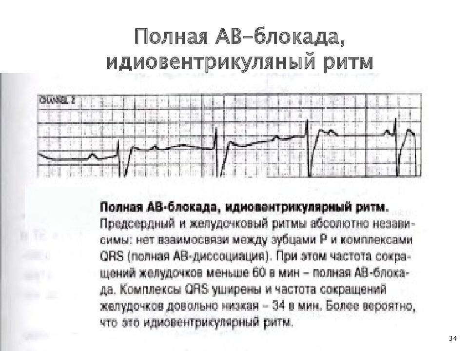 Давление блокада. ЧСС при полной АВ блокаде. Ритм при полной АВ блокаде. Какой Рим при полной АВ блокаде. Полная блокада замещающим желудочкового ритма.