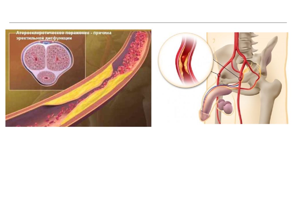 Эректильная функция. Эректильная дисфункция фото. Фото для эректильной дисфункции. Сосудистая эректильная дисфункция. Эякуляторная дисфункция.